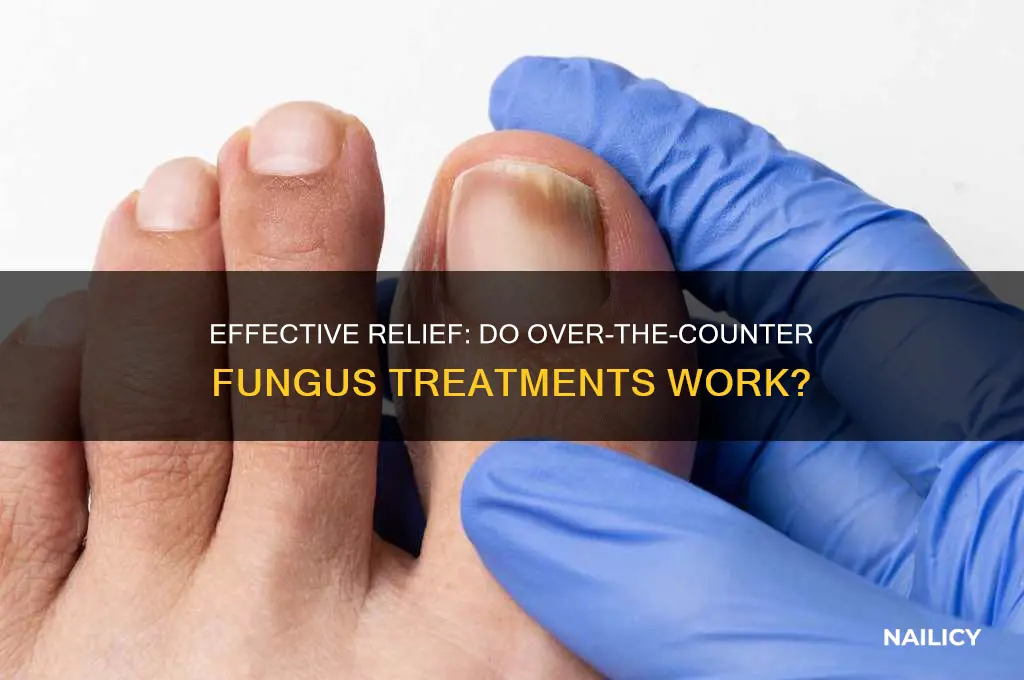 do over the counter finger nail fungus treatments work