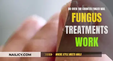 Effective OTC Nail Fungus Treatments: Do They Work?
