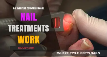 Over-the-Counter Fungal Nail Treatments: Effective Solutions or Just a Myth?