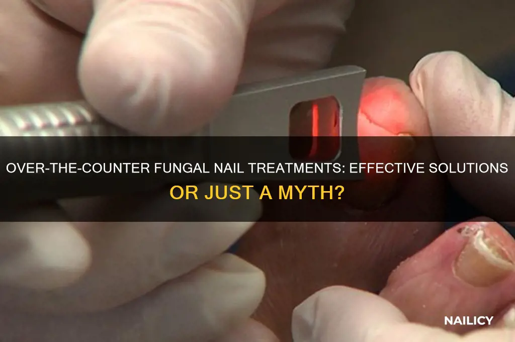 do over the counter fungal nail treatments work