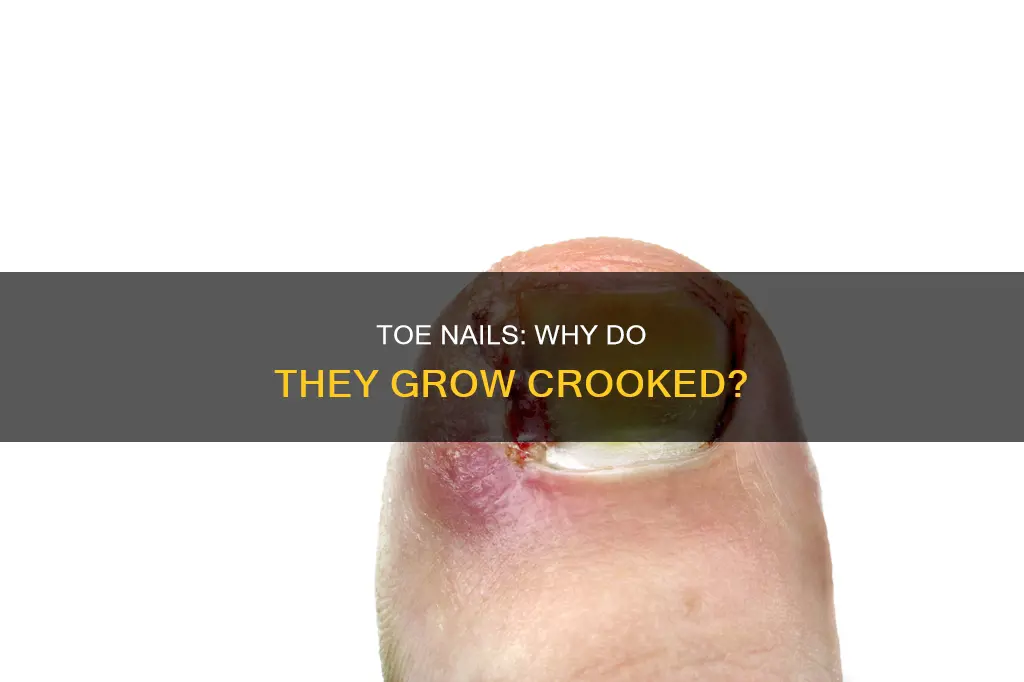 do toe nails keep grow crooked