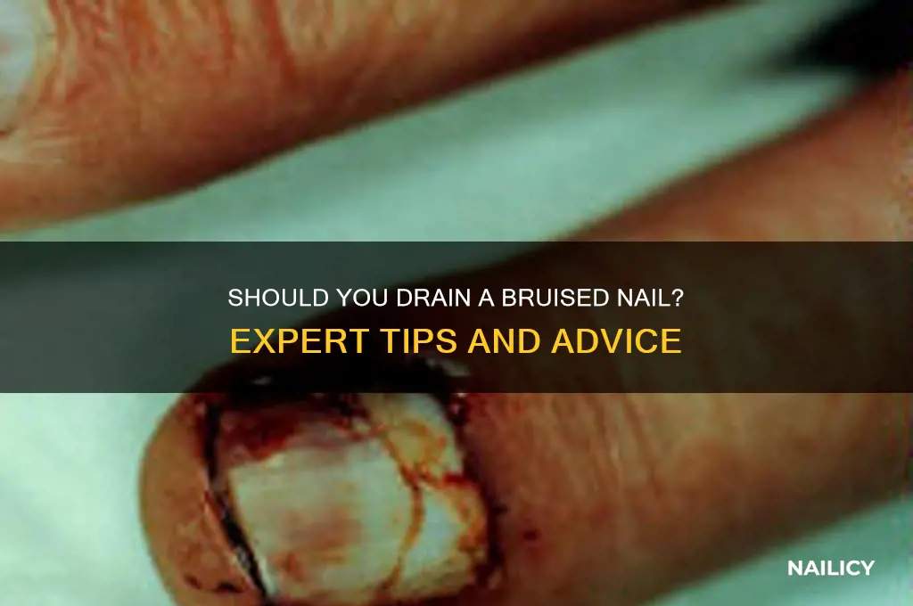 do you have to drain a bruised nail