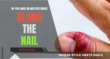 How to Lance an Infected Finger at Home