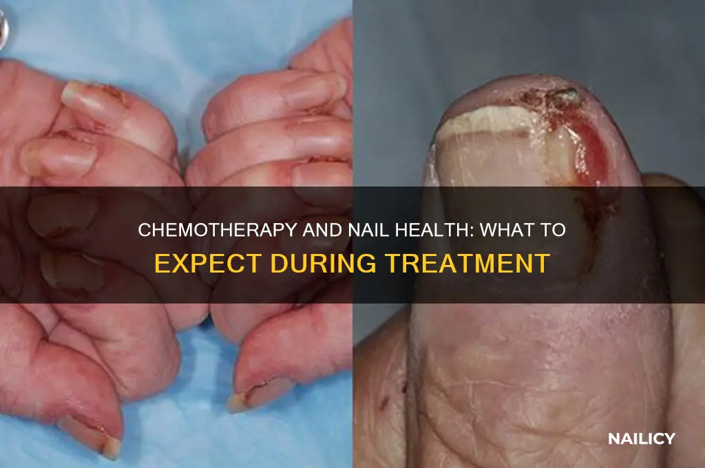 do you lose your nails with chemo
