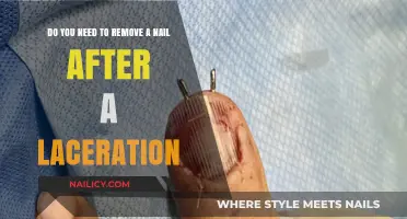 When to Remove Nails After a Laceration