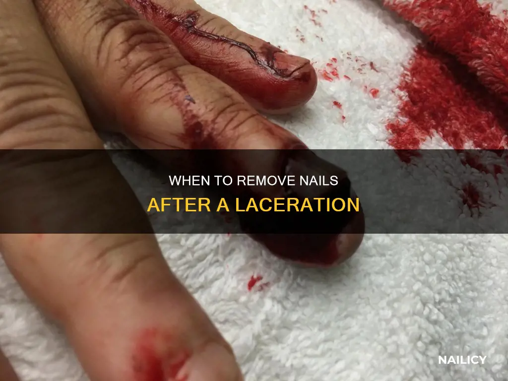 do you need to remove a nail after a laceration