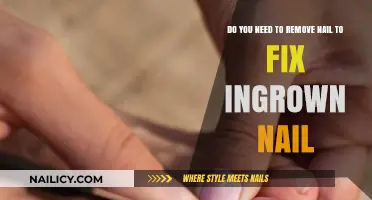 Fixing Ingrown Nails: Is Nail Removal Necessary?