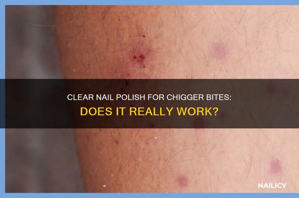 do you put clear nail polish on chigger bites