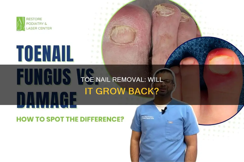 does a toe nail grow back after removal