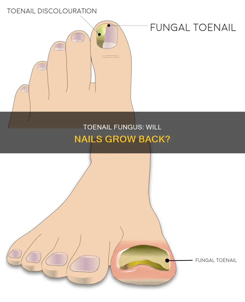 does a toenail grow back after nail fungus