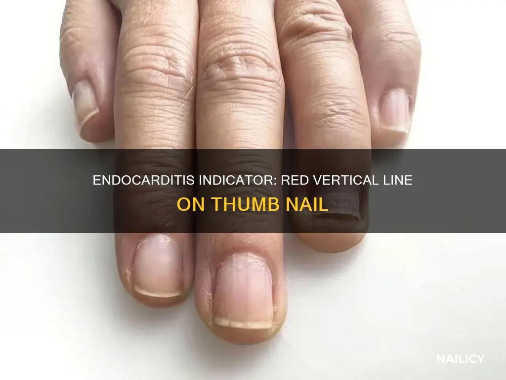 does a vertical red line on thumb nail mean endocarditis