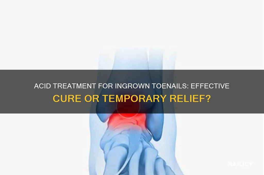 does acid treatment on nails cure ingrown toenail