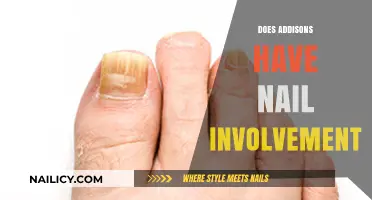 Addison's Disease and Nail Health: Uncovering Potential Symptoms and Changes