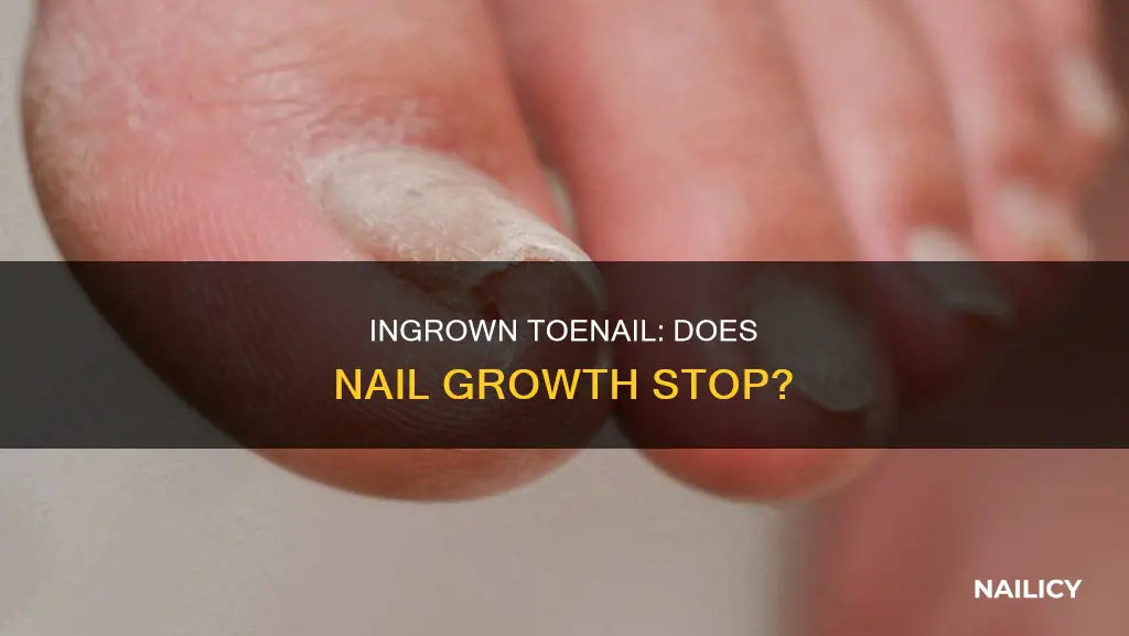 does an ingrown toe nail make the nail stop growing