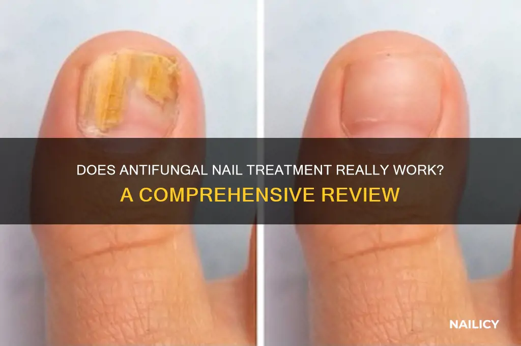 does anti fungal nail work