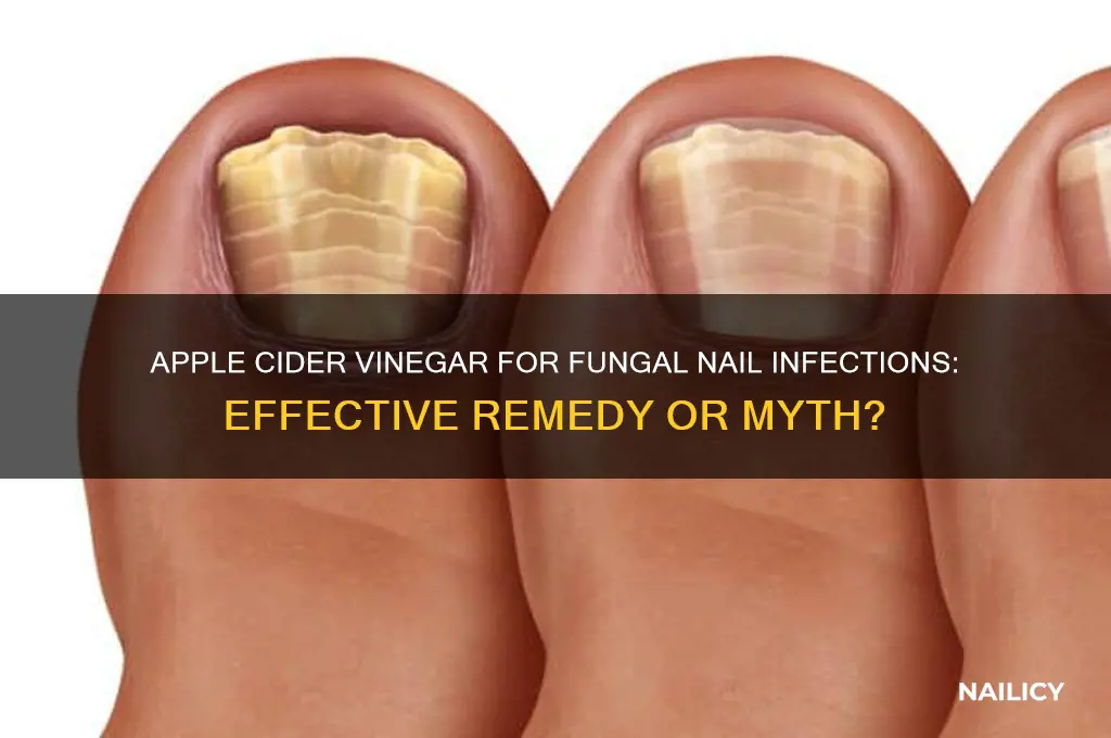 does apple cider vinegar help fungal nail infections