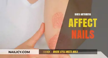 Arthritis and Nail Health: Uncovering the Surprising Connection and Symptoms