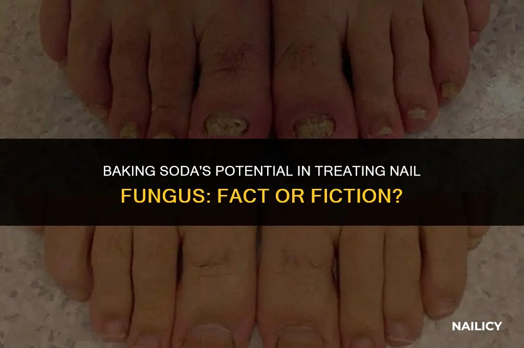 does baking soda get rid of nail fungus