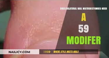 Bilateral Nail Matrixectomies: Understanding the Need for Modifier 59