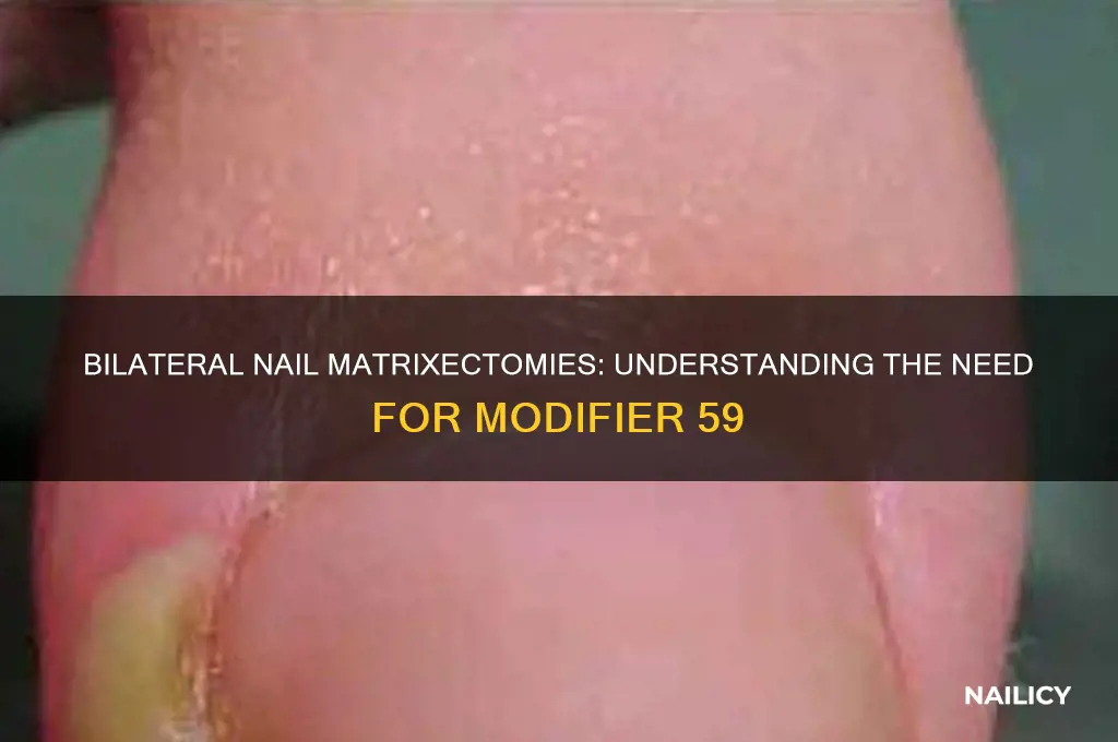 Bilateral Nail Matrixectomies: Understanding The Need For Modifier 59 ...