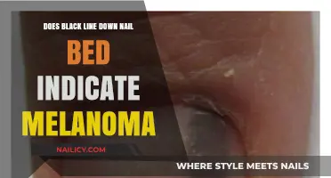 Black Line on Nail Bed: Melanoma Warning Sign or Harmless?