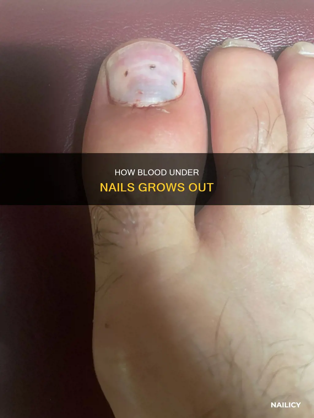does blood under nail grow out