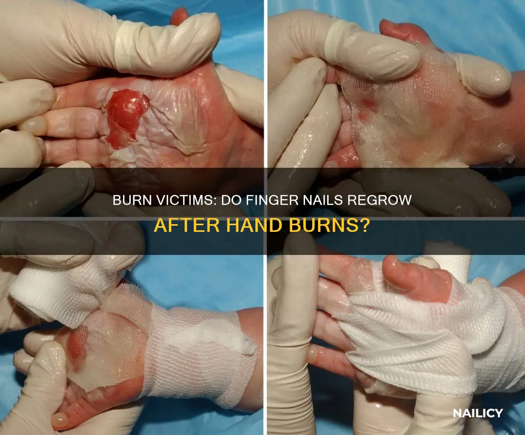 does burn victims have finger nails after hand burns