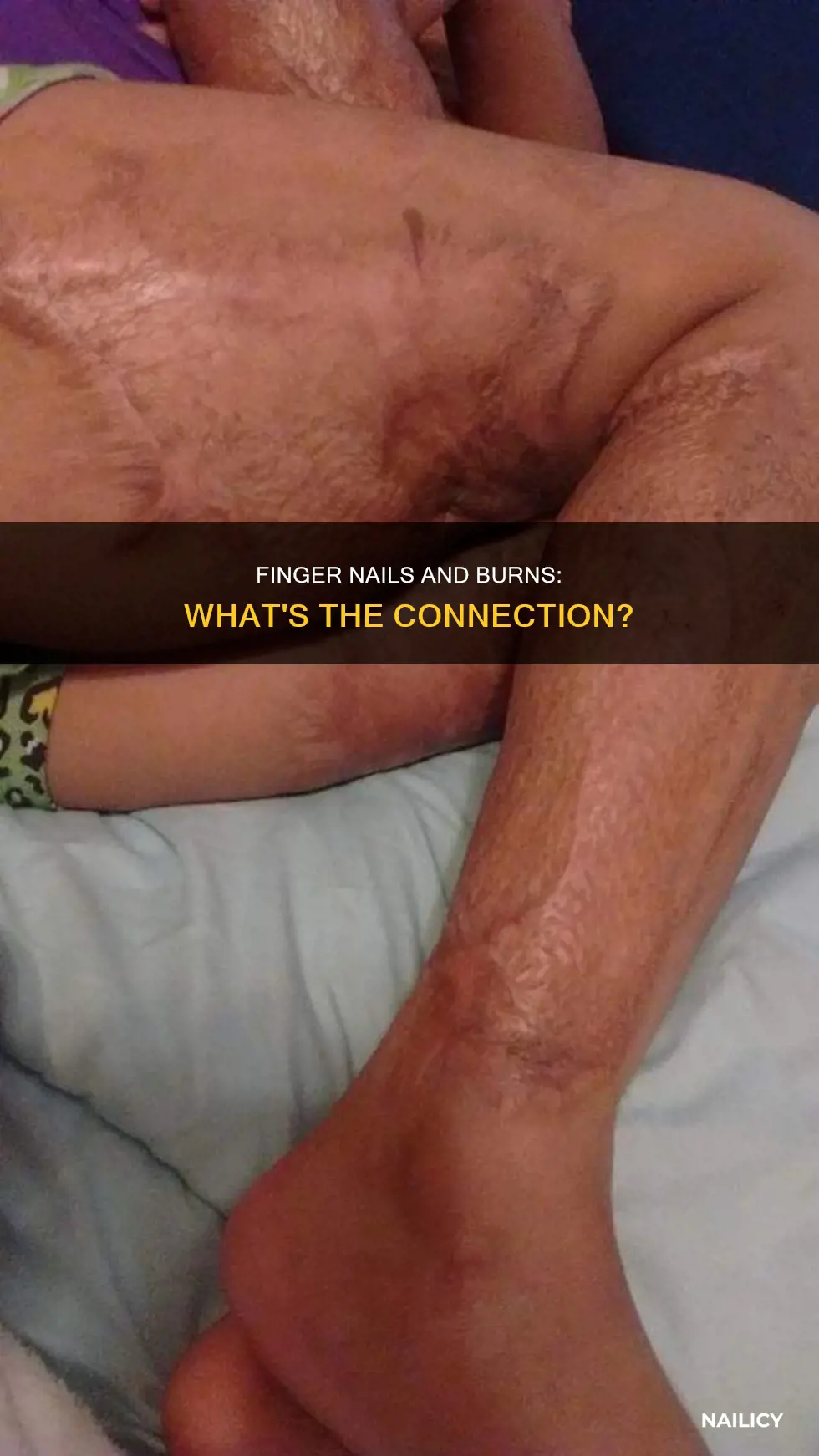 does burn victims have finger nails after hand burns