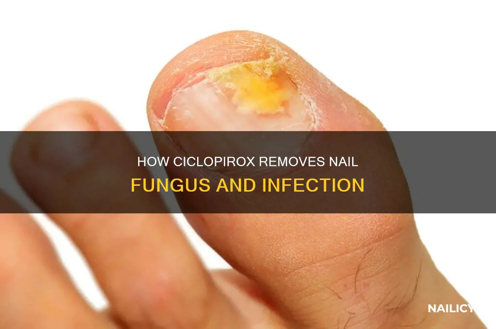 does ciclopirox make your nail fall off