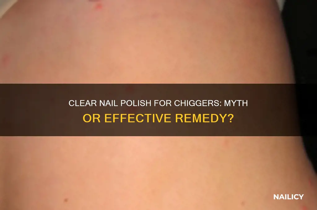 does clear finger nail polish kill chiggers