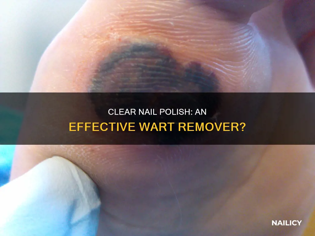 does clear nail polish help remove warts