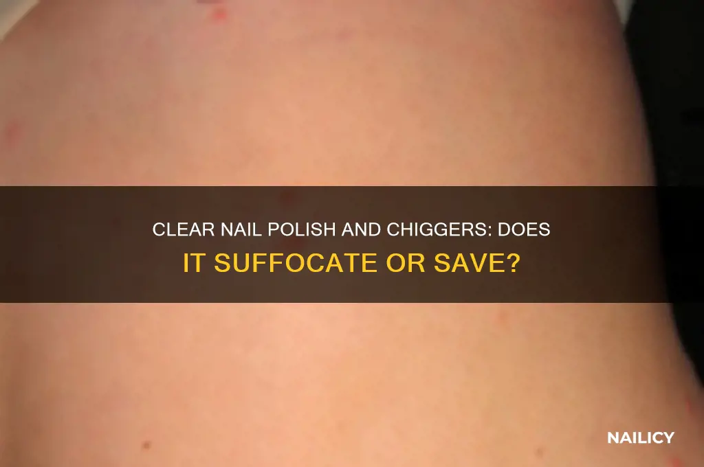 does clear nail polish suffocate chiggers