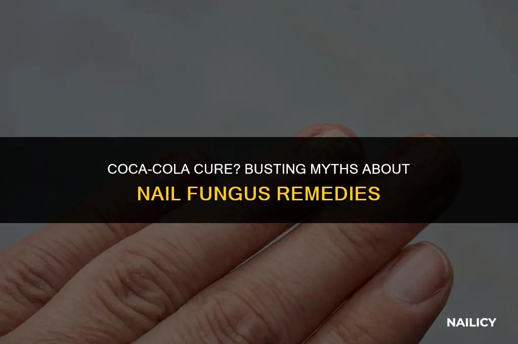 does coca cola get rid of nail fungus