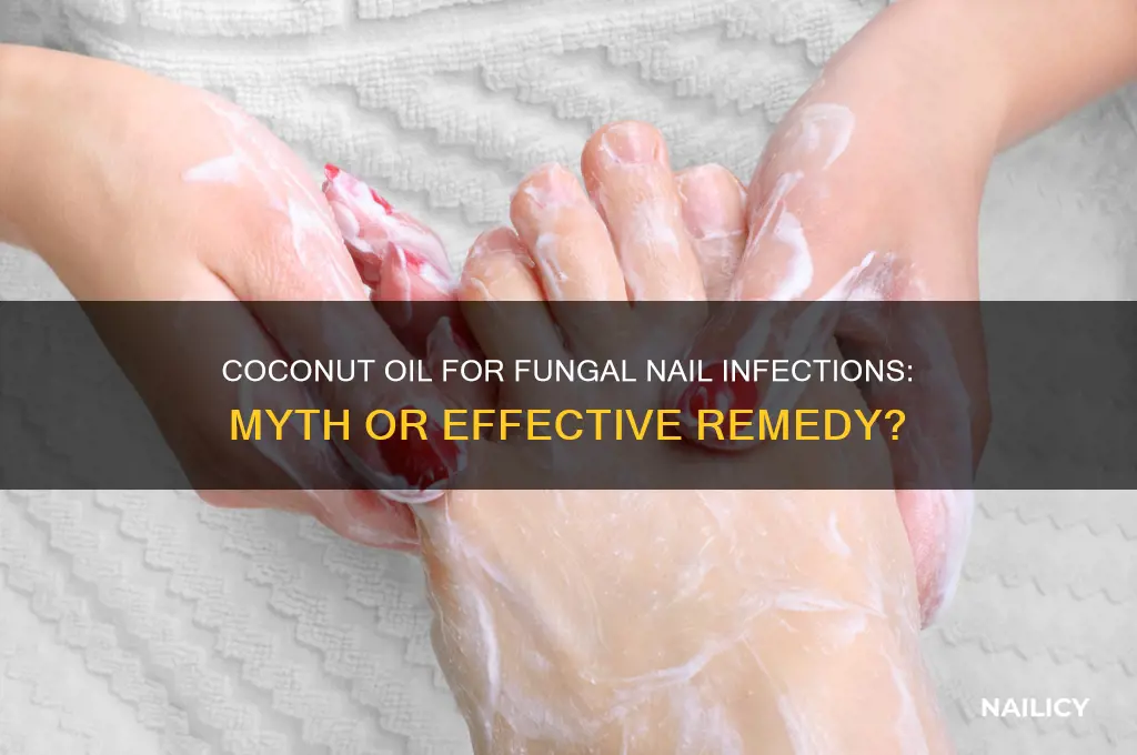 does coconut oil cure fungal nail infection
