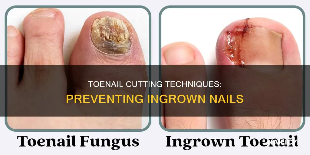 does cutting toenails around edges cause ingrown nails