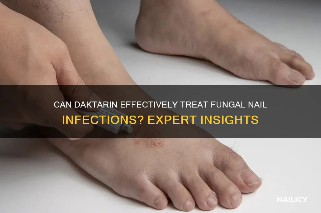 does daktarin treat fungal nail