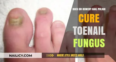 Can Dr. Remedy Nail Polish Effectively Treat Toenail Fungus?