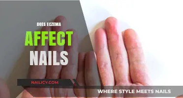 Eczema and Nail Health: Understanding the Impact and Symptoms