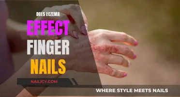 Eczema's Impact: Unveiling the Connection to Finger Nails