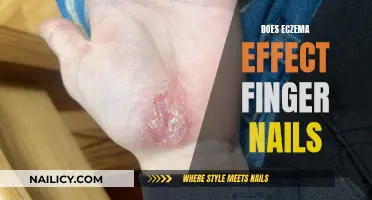 Eczema's Impact: Fingernails and Beyond