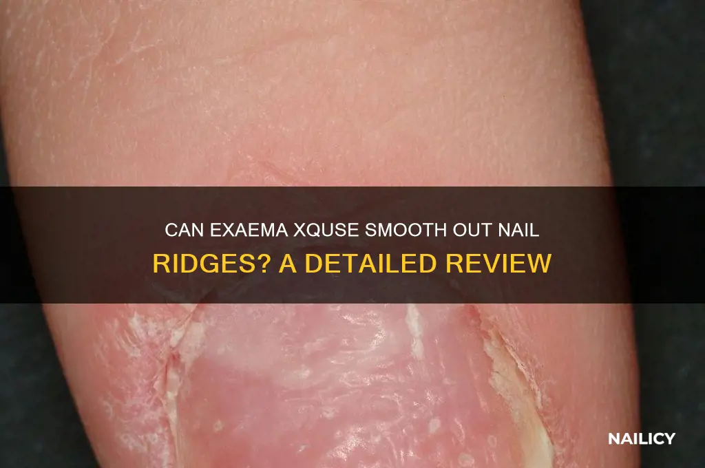 does exaema xquse nail ridges