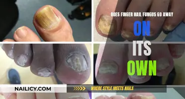 Nail Fungus: Can It Heal Without Treatment?