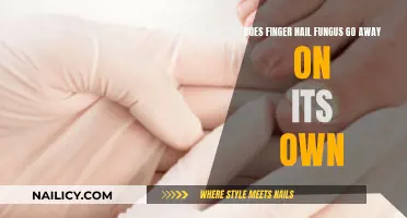 Fingernail Fungus: Can It Be Cured Without Treatment?