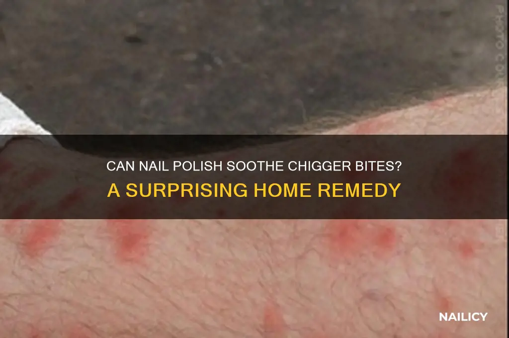 does finger nail polish help chigger bites