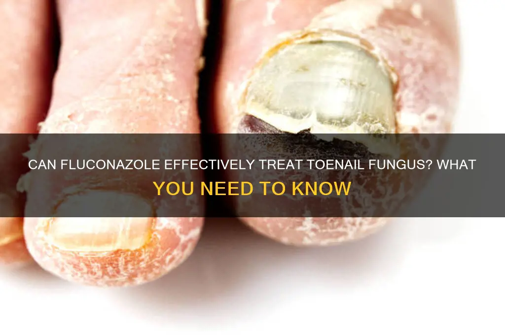 does fluconazole treat nail infection
