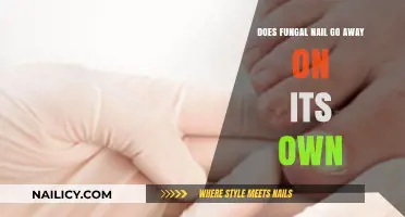 Can Fungal Nail Infections Heal Without Treatment? Facts and Insights
