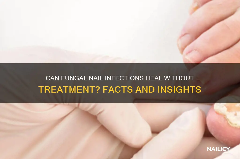 does fungal nail go away on its own