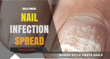 Can Fungal Nail Infections Spread? Understanding Transmission and Prevention