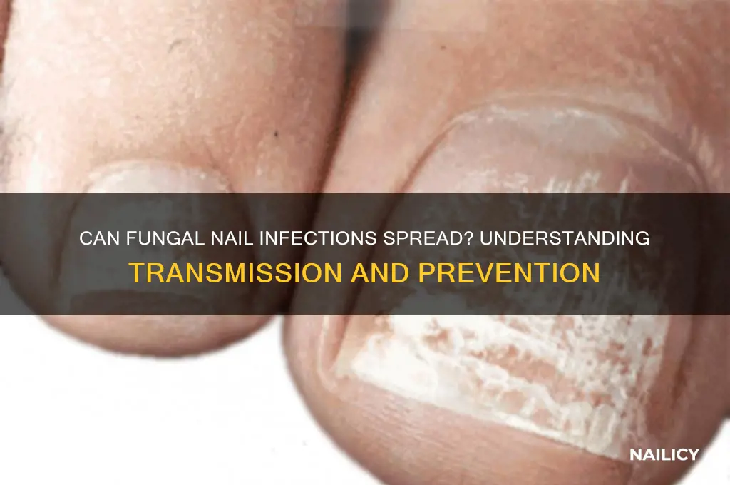 does fungal nail infection spread