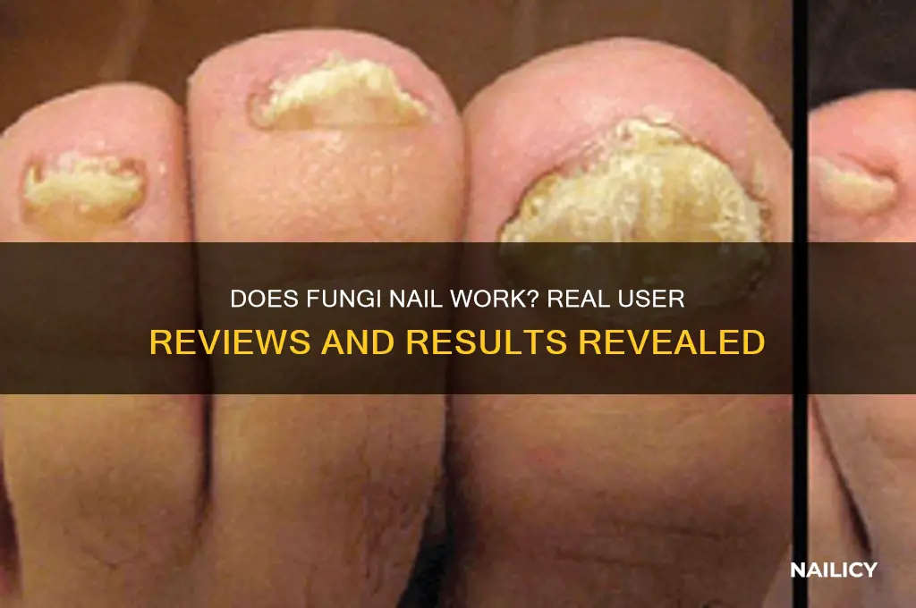 does fungi nail work reviews
